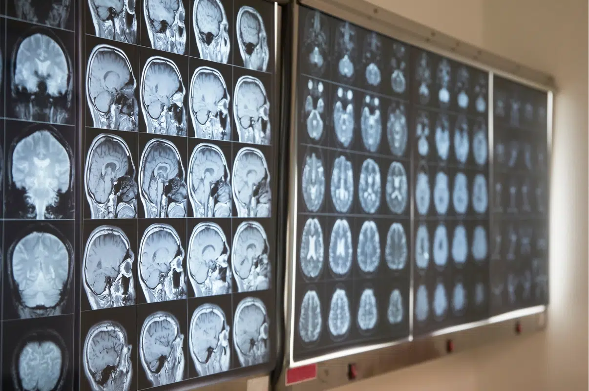 Radiology MRI scans of the brain